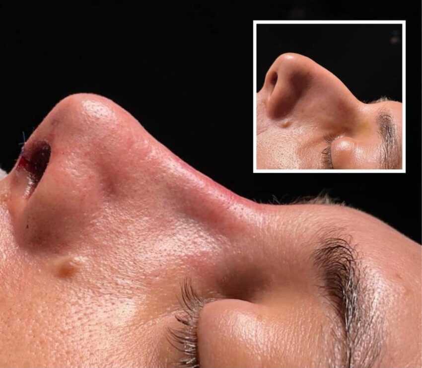 Cu un nas perfect te naști sau… îl creezi!  Despre rinoplastie. O provocare estetică și medicală